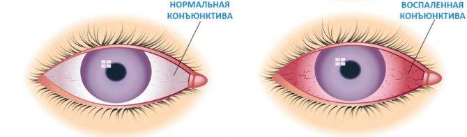 Как передается конъюнктивит глазной у взрослых, заразен или нет воздушно-капельный путь, сколько дней можно заразиться от человека