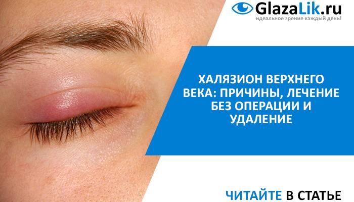Лечение халязиона века в домашних условиях - "здоровое око"