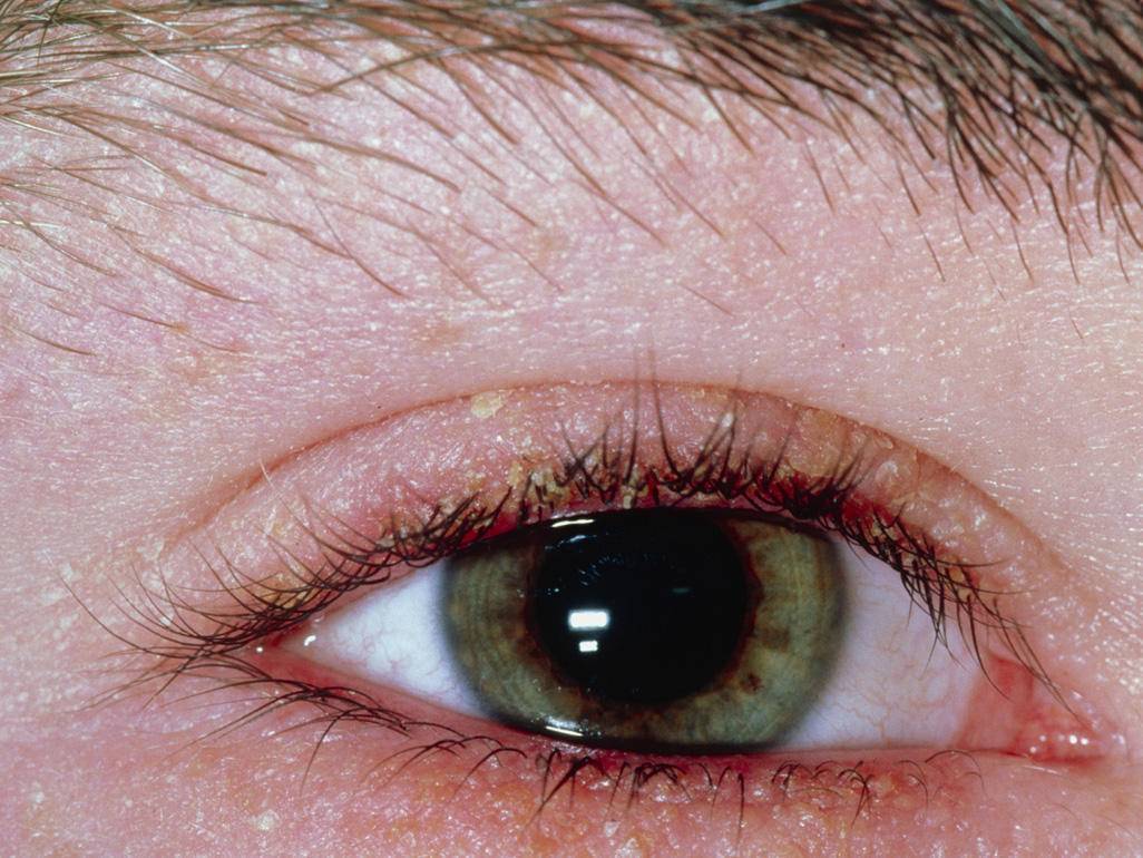 Сухость и шелушение кожи под глазами. причины и способы лечения кожи век