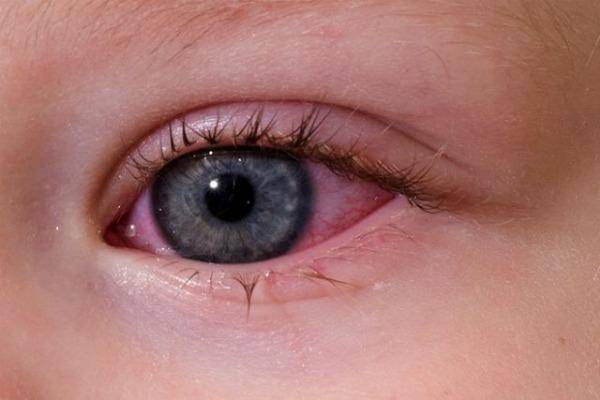 Почему красные глаза у ребенка: 5 основных причин