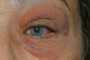 Почему чешется глаз в уголке около носа — allergich.com