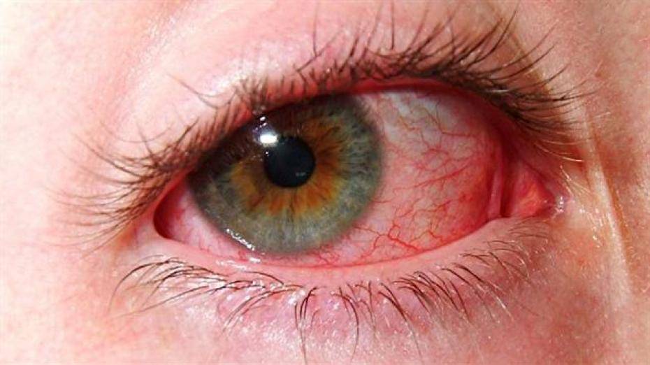 Красные пятна под глазами у ребенка: причины их появления, точек, прыщиков и различного рода сыпи на веках