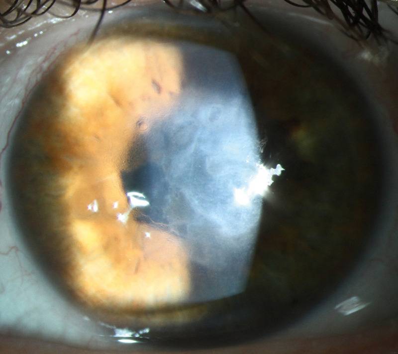 Что такое дистрофия роговицы глаза: симптомы, лечение oculistic.ru
что такое дистрофия роговицы глаза: симптомы, лечение