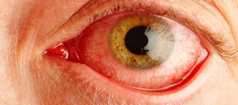 Если застудил глаз какие симптомы и лечение. продуло глаз у ребенка. воспаление глаз у ребенка - помощь медика