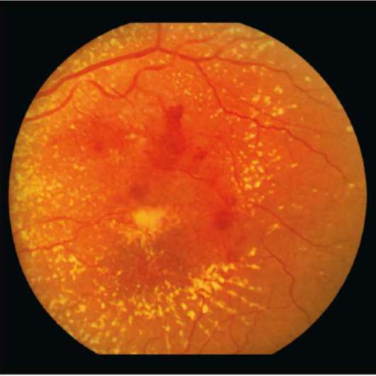 Ретинопатия: понятие, формы, типы, диагностика, лечение - "здоровое око"