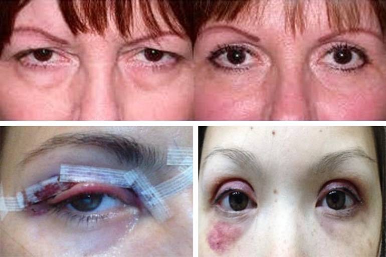 Лечение глазных болезней: удаление халязиона