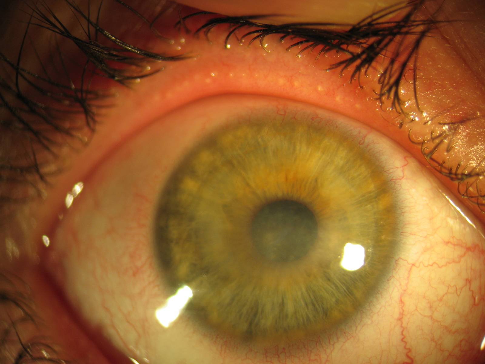 Отслоение роговицы глаза - симптомы, лечение, причины