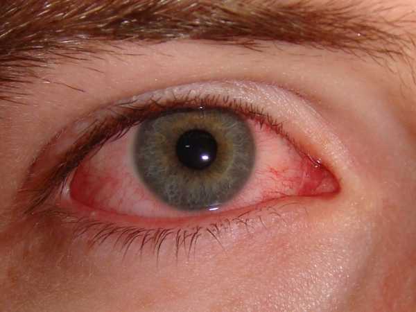 Почему болят глаза после линз и что с этим делать