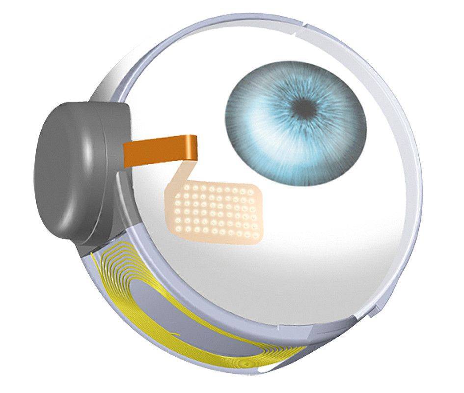 Бионический глаз – искусственная зрительная система - о болезнях