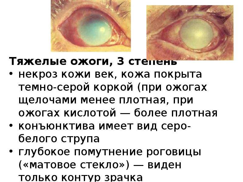 Ожог глаз кварцевой лампой: лечение, первая помощь, возможные последствия и осложнения - мир здоровья
