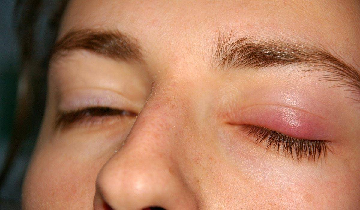Опухло и болит верхнее веко глаза: причины, чем лечить в домашних условиях oculistic.ru
опухло и болит верхнее веко глаза: причины, чем лечить в домашних условиях