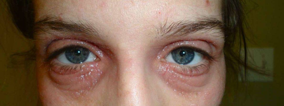 Красные пятна под глазами - причины шелушения вокруг глаз