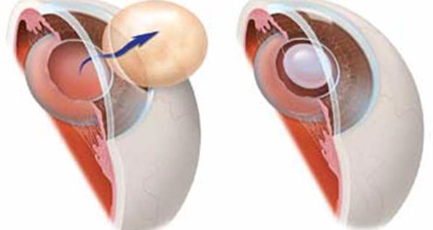 Экстракция катаракты (экстракапсулярная, интракапсулярная) с имплантацией иол