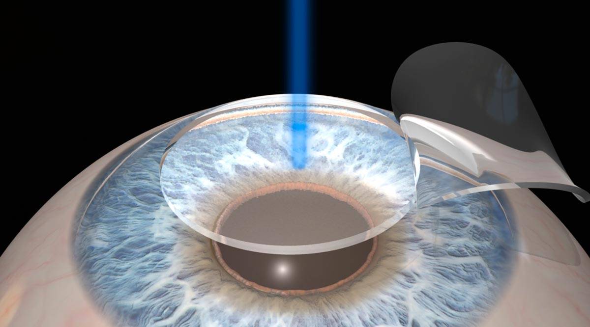 Какой хрусталик лучше при катаракте – советы офтальмолога