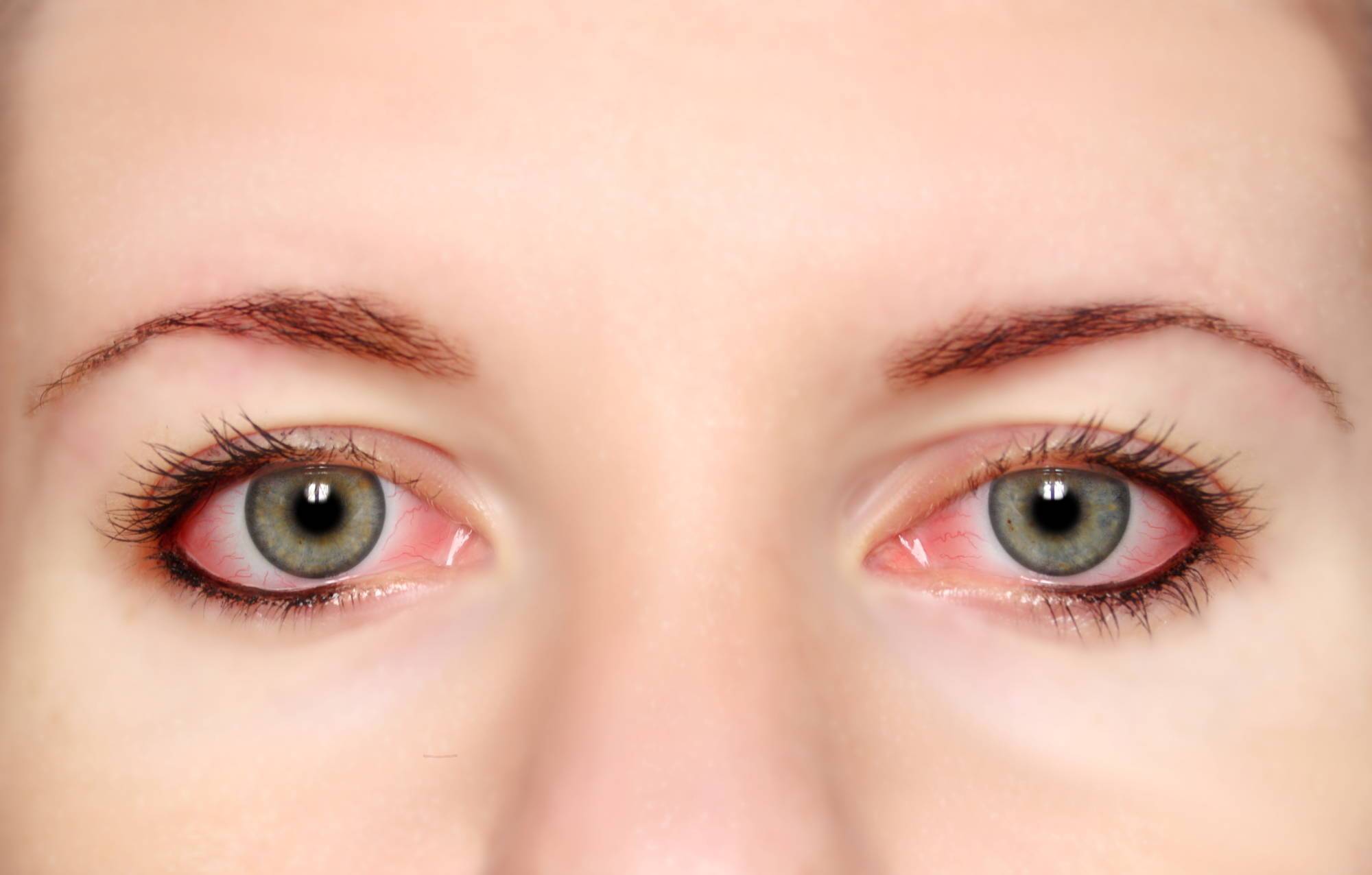 Чем лечить покрасневший глаз в домашних условиях