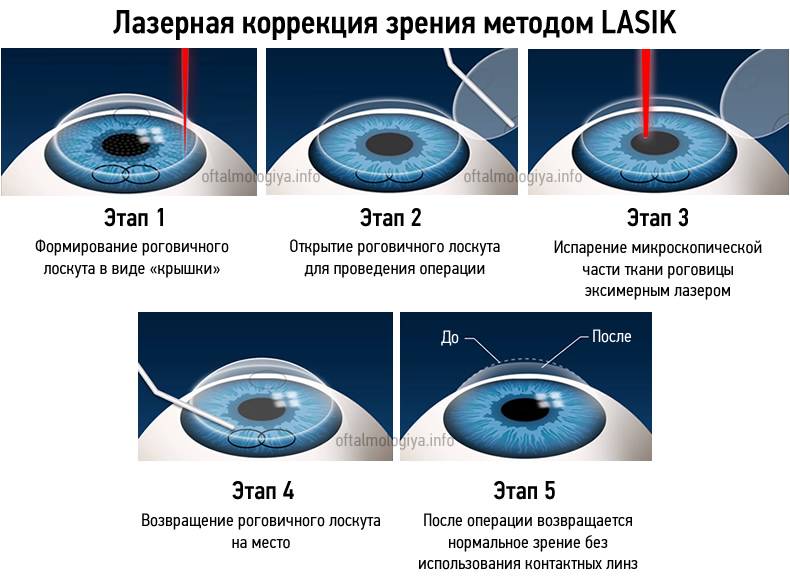 Ограничения после проведения лазерной коррекции зрения