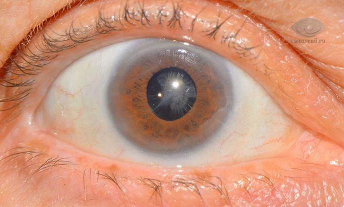 Ядерная катаракта у пожилых людей: что это такое, причины, симптомы различных видов, лечение бурой и старческой форм заболевания, профилактика