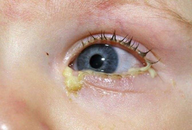 При простуде у ребенка гноятся глаза