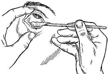 Глазная тетрациклиновая мазь для детей: инструкция по применению тетрациклина при конъюнктивите, как закладывать мазь в глаз ребенку до года
