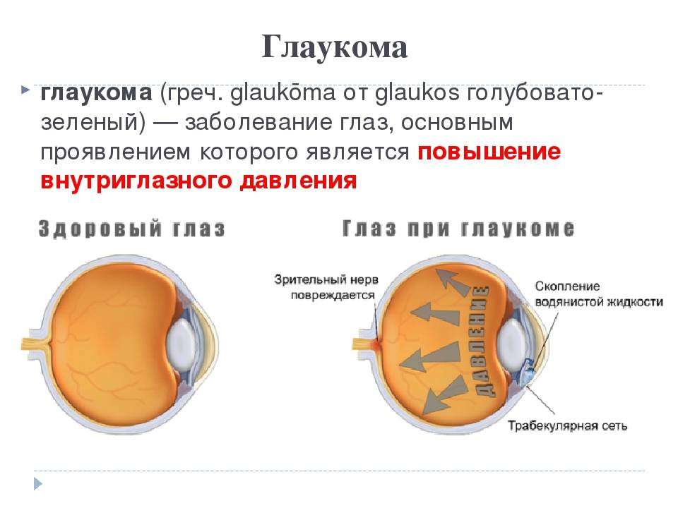 Открытоугольная глаукома: причины, симптомы, лечение и профилактика