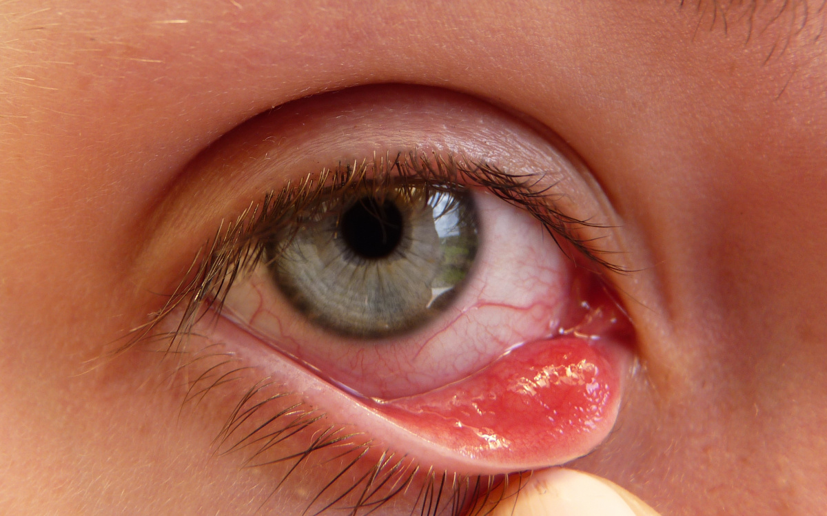 Внутренний ячмень на верхнем или нижнем веке: лечение внутри глаза, как лечить