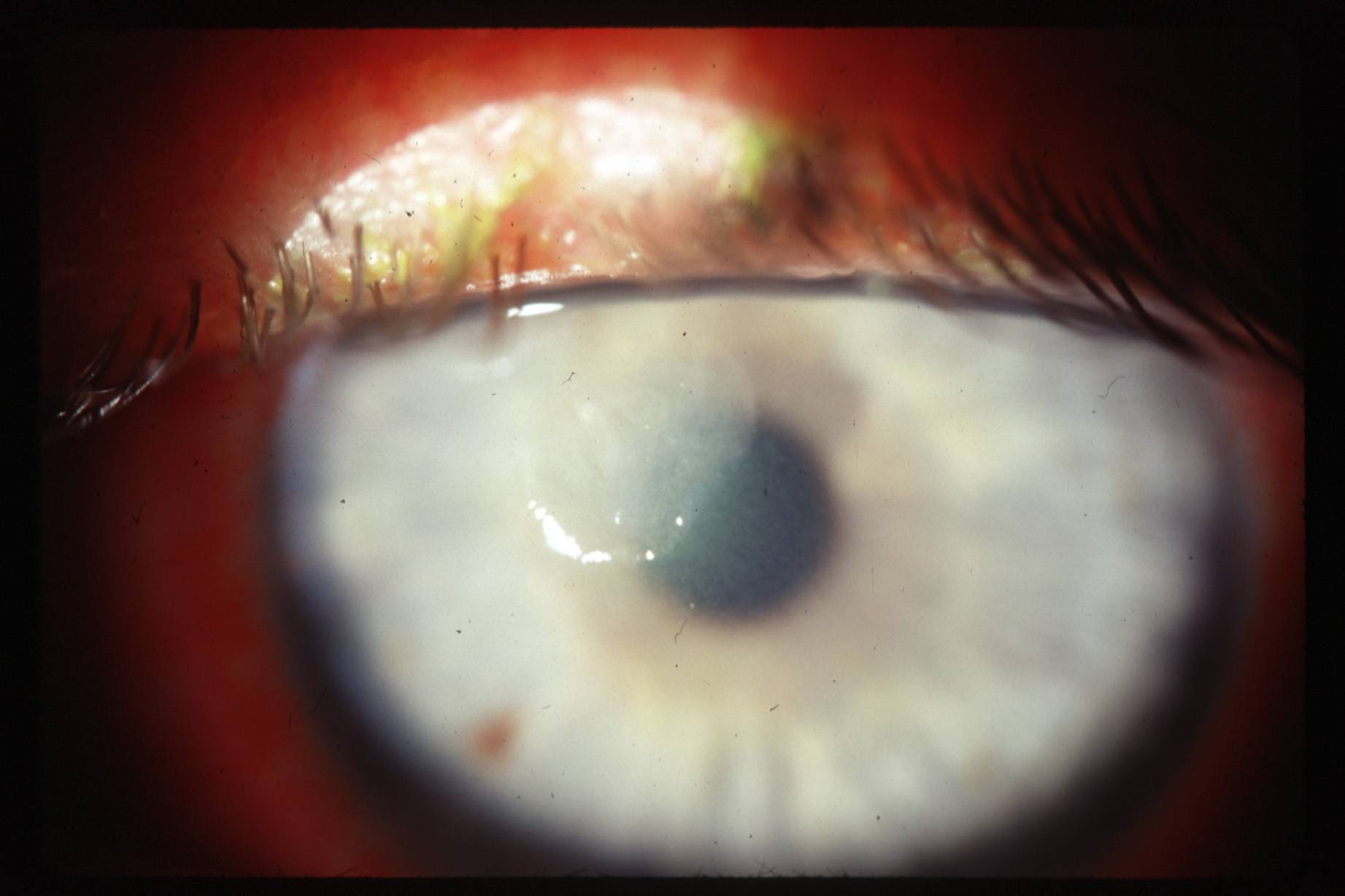 Кератит глаз — симптомы и лечение, фото, причины возникновения у взрослых, у детей