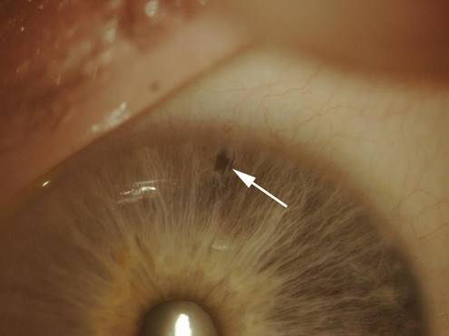 Лазерная базальная иридэктомия как эффективный метод лечения глаукомы