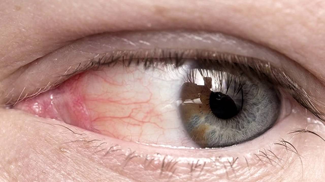 Что делать, если сосуд лопнул в глазу: виды кровоизлияний и лечение