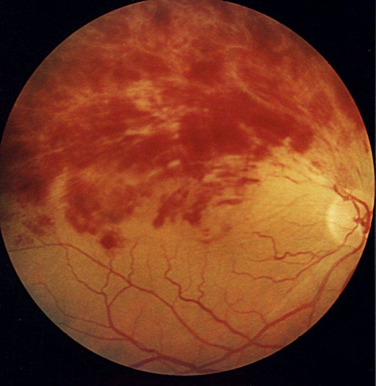Кровоизлияние в глаз: причины, симптомы и лечение