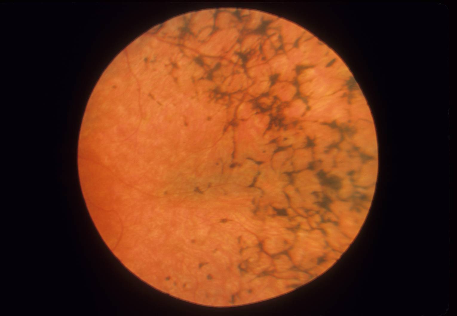 Дистрофия сетчатки глаза: что это такое, опасно ли это, виды заболевания, симптомы, диагностика и профилактика