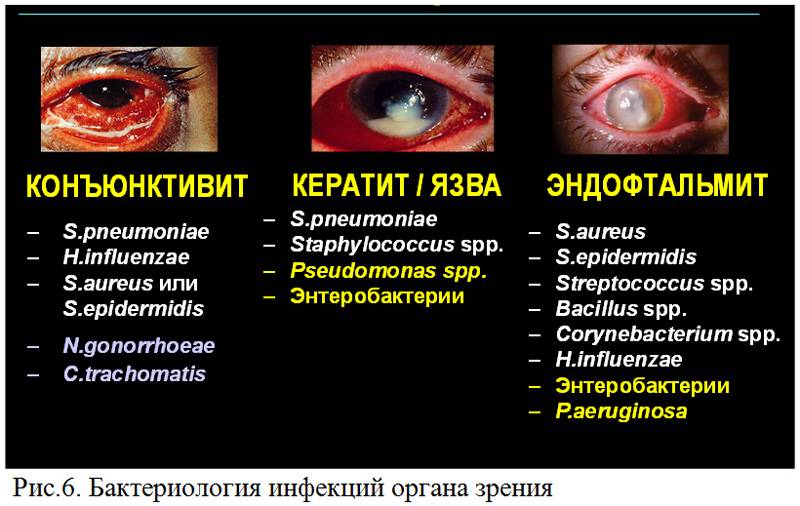 Эндофтальмит: причины, симптомы, лечение воспаления глаза