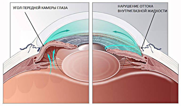 Иридэктомия: лазерное лечение глаукомы, последствия операций