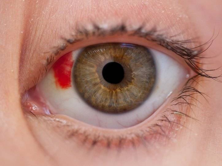 Разрыв глазного яблока - причины, диагностика и лечение
