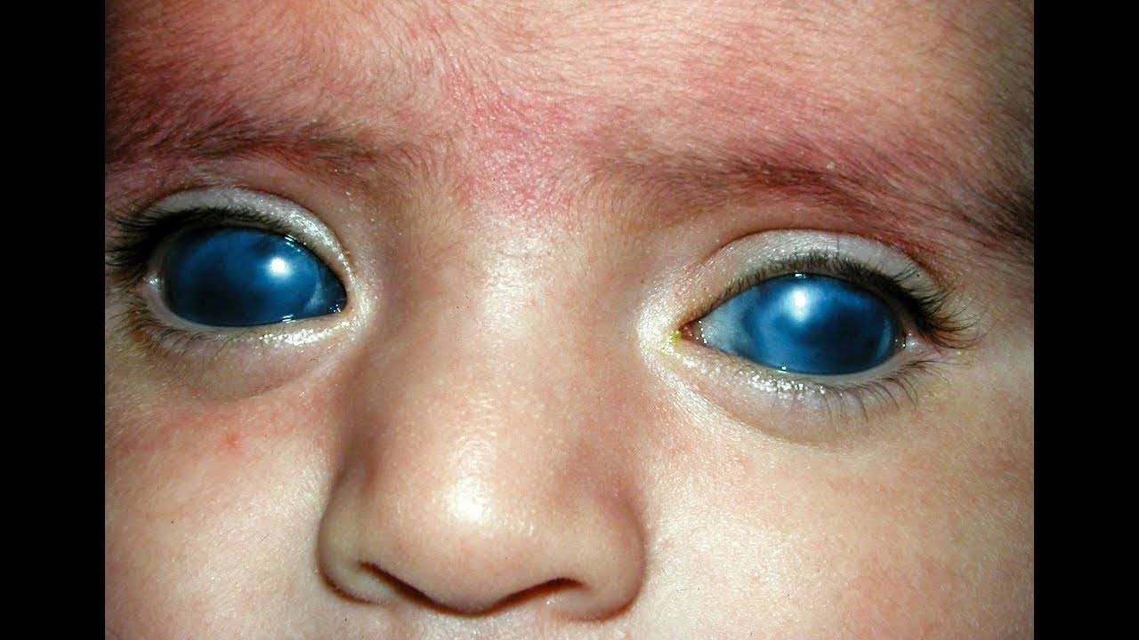 Врожденная глаукома: причины и последствия патологии у детей, методы лечения