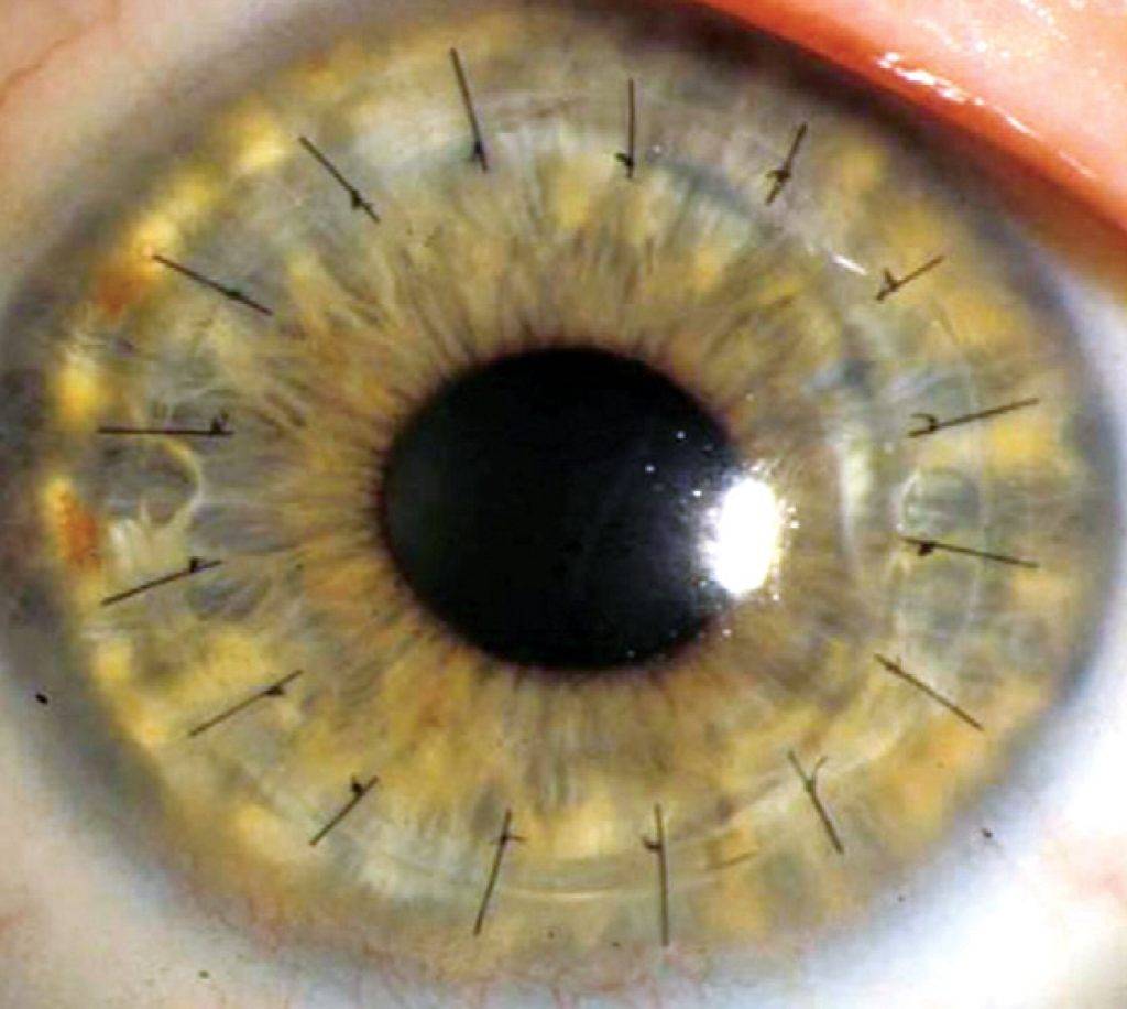 Пересадка роговицы глаза - кератопластика, противопоказания