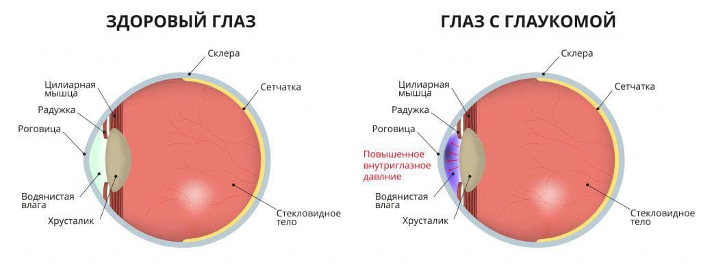 Скиаскопия на фоне циклоплегии