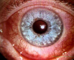 Эписклерит глаза: фото, причины заболевания, симптомы болезни, лечение острого и узелкового эписклерита