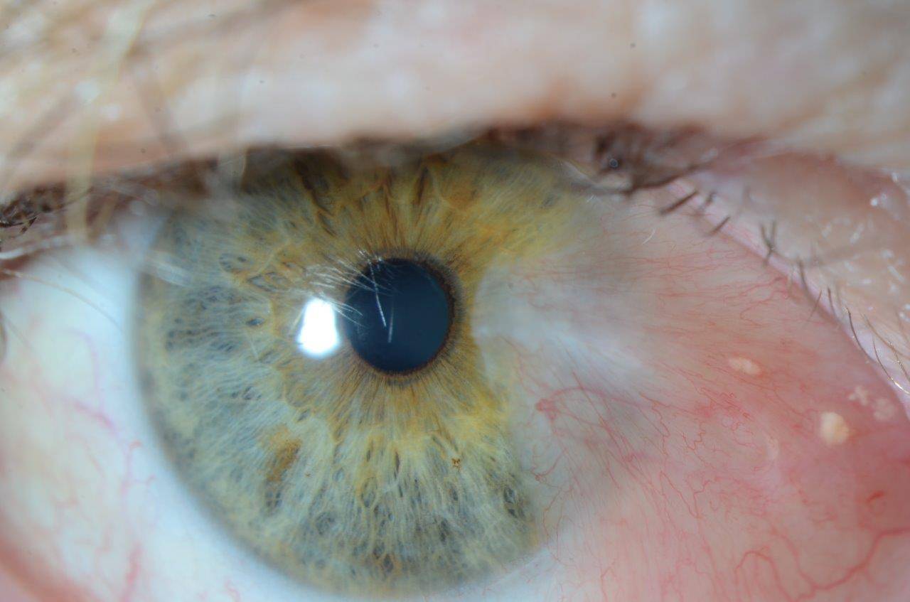 Пингвекула глаза: симптомы, причины и методы лечения - "здоровое око"
