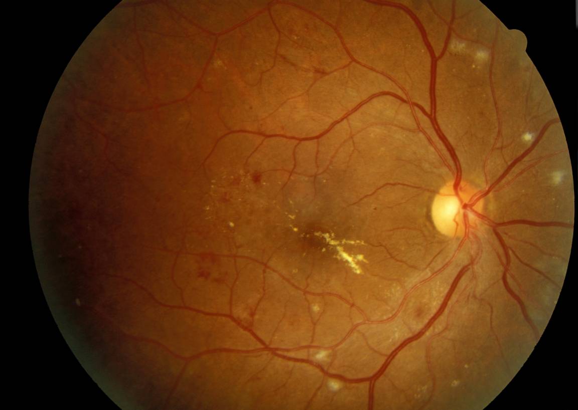 Разрыв сетчатки глаза: причины, симптомы и лечение
