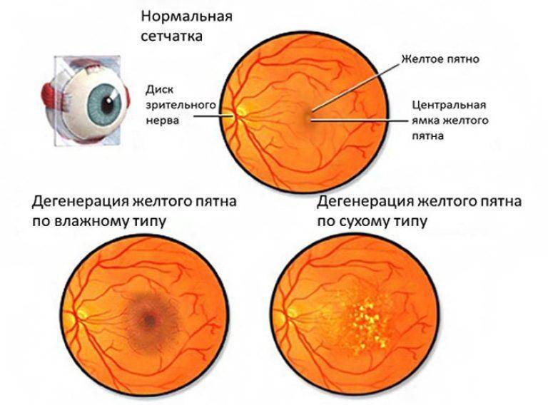 Как проходит операция при макулярном разрыве сетчатки глаза и особенности периода восстановления