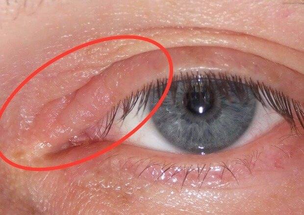 Боль в уголках глаз: причины и лечение - "здоровое око"