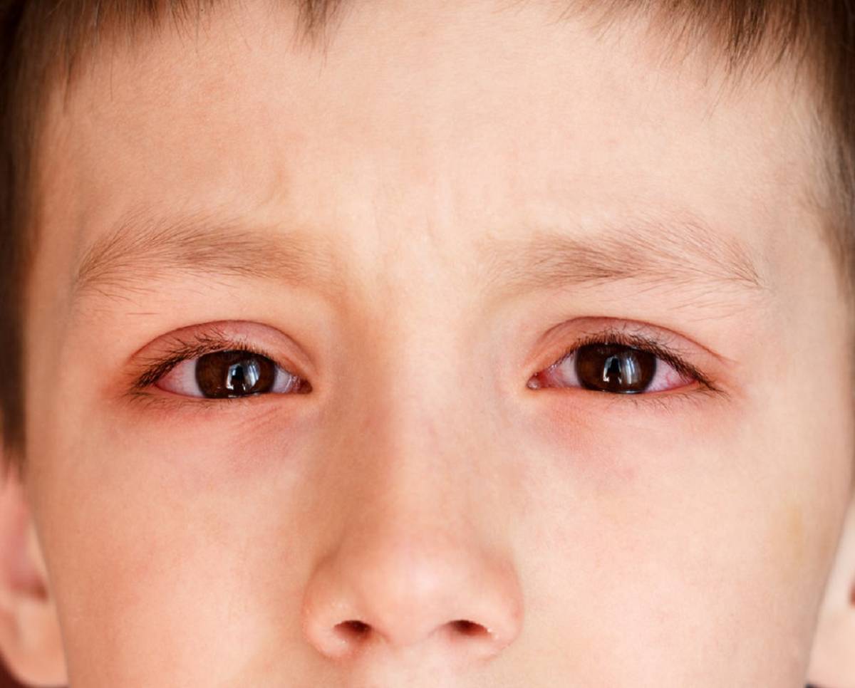 Аллергия: покраснение глаз и отек, насморк, чихание и другие симптомы