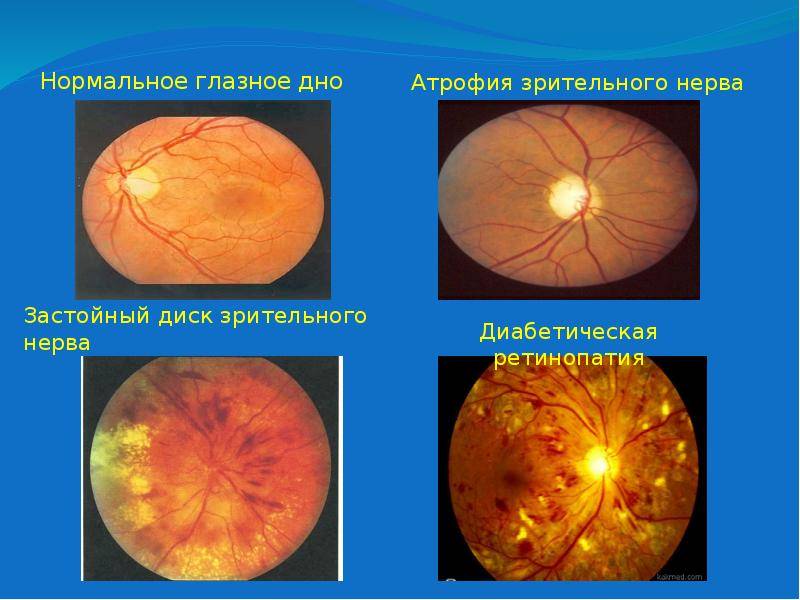 Застойный диск зрительного нерва: причины, симптомы и лечение