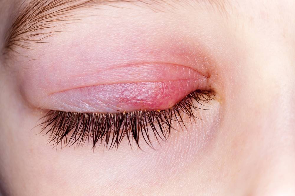 Наружный (внешний) ячмень на глазу: симптомы и лечение