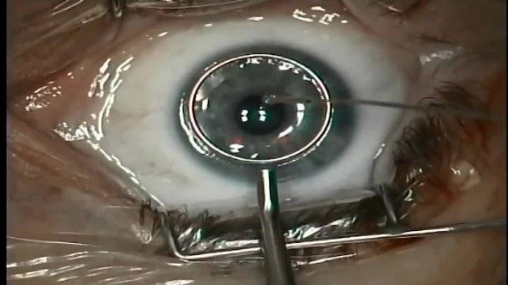 Как восстанавливается зрение после лазерной коррекции