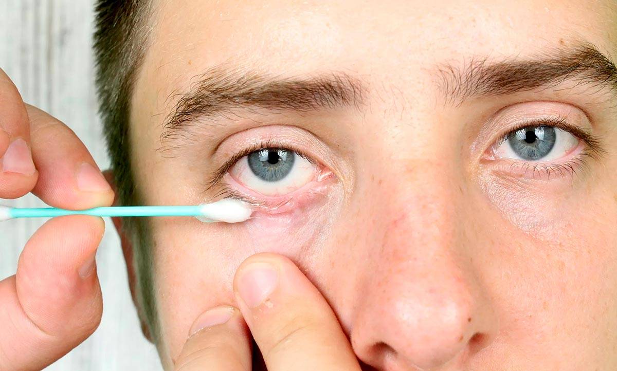 Ячмень на глазу - лечение, причины, симптомы, мазь от ячменя на глазу