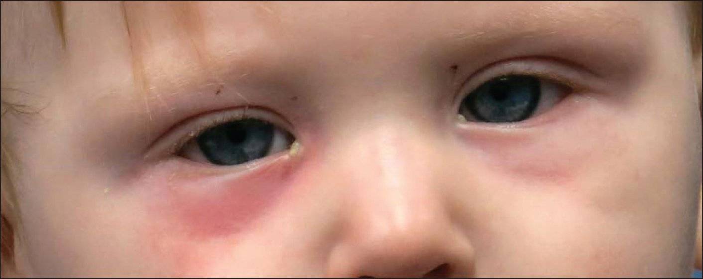  в помощь маме: почему появляются красные круги под глазами у ребенка?