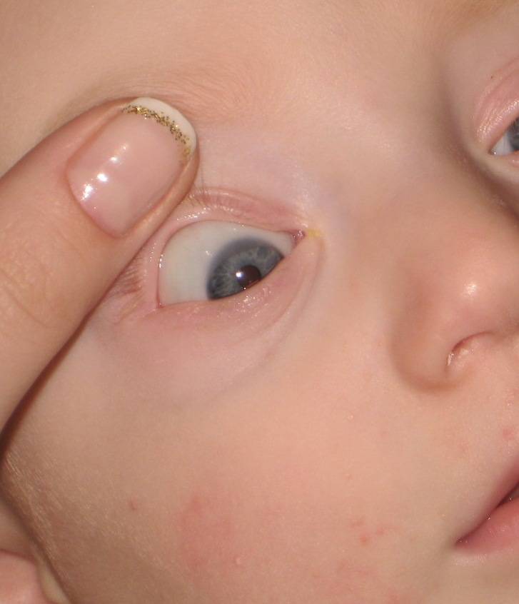 Почему возникают выделения из глаз у новорожденного?