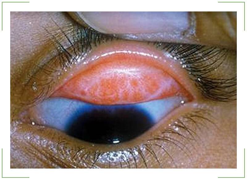 Болезни глаз у человека: список заболеваний, симптомы, лечение, причины, названия, фото