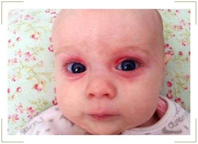 Причины покраснения под глазами у ребенка